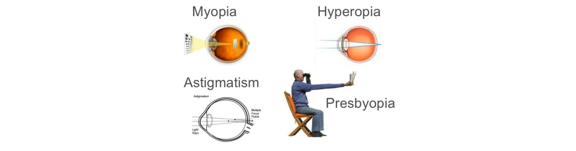 Τι είναι μυωπία, υπερμετρωπία, αστιγματισμός και πρεσβυωπία;